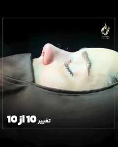 Three-months-after-fleshy-rhinoplasty-12
