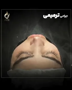 Three-months-after-fleshy-rhinoplasty-13