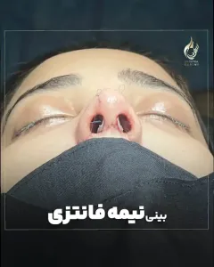 Three-months-after-fleshy-rhinoplasty-14