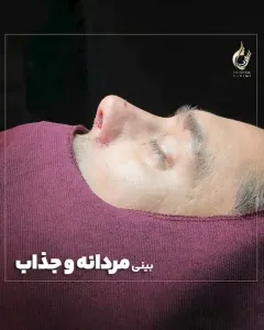 Three-months-after-fleshy-rhinoplasty-15