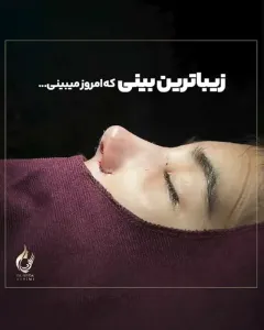Three-months-after-fleshy-rhinoplasty-16