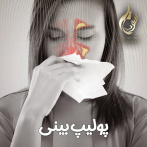 پولیپ بینی - دکتر سودا کریمی