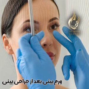 ورم بینی بعد از جراحی بینی - https://drsevdakarimi.com/