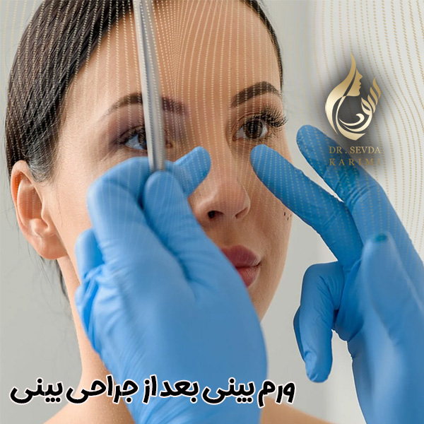 ورم بینی بعد از جراحی بینی - https://drsevdakarimi.com/