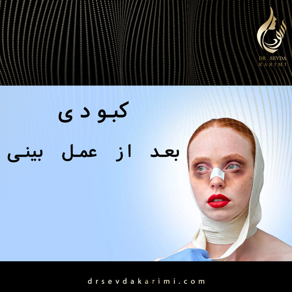 کبودی بعد از عمل بینی https://drsevdakarimi.com/