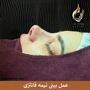 جراحی بینی نیمه فانتزی _ دکتر سودا کریمی 