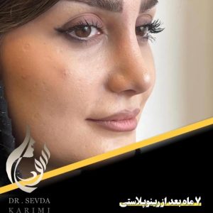 عمل بینی گوشتی _ دکتر سودا کریمی
