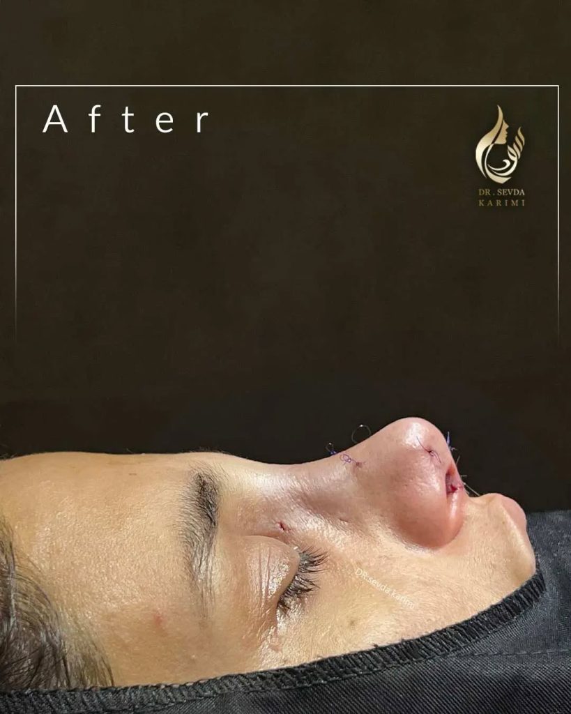 Excellent rhinoplasty result
