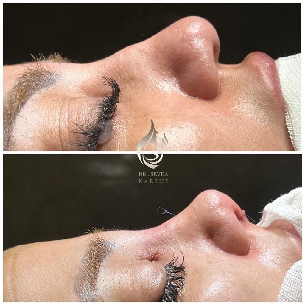 Fleshly nose immediately after rhinoplasty