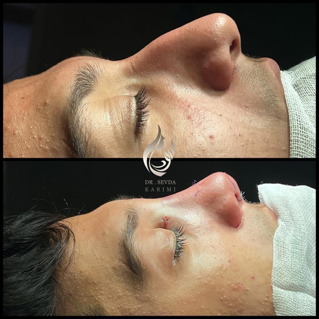 Male rhinoplasty