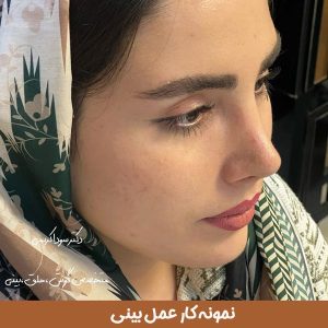 نمونه کار بهترین جراح بینی تبریز _ دکتر سودا کریمی