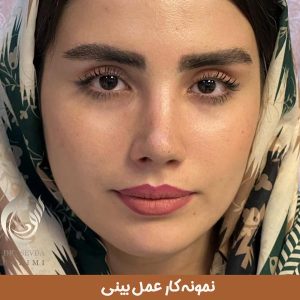 نمونه کار بهترین جراح بینی تبریز _ دکتر سودا کریمی