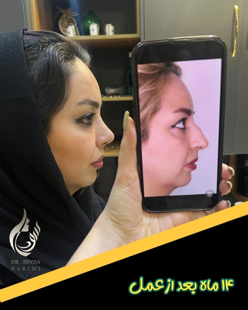 Semi-fantasy rhinoplasty