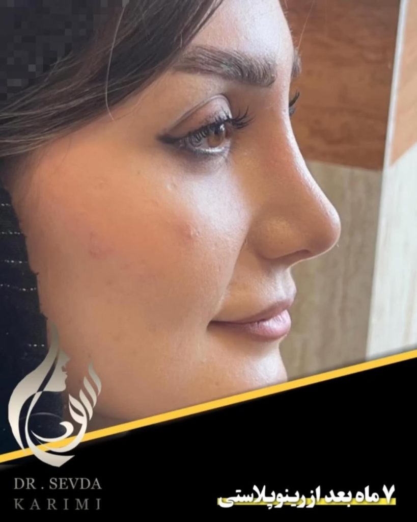 Seven months after fleshy rhinoplasty