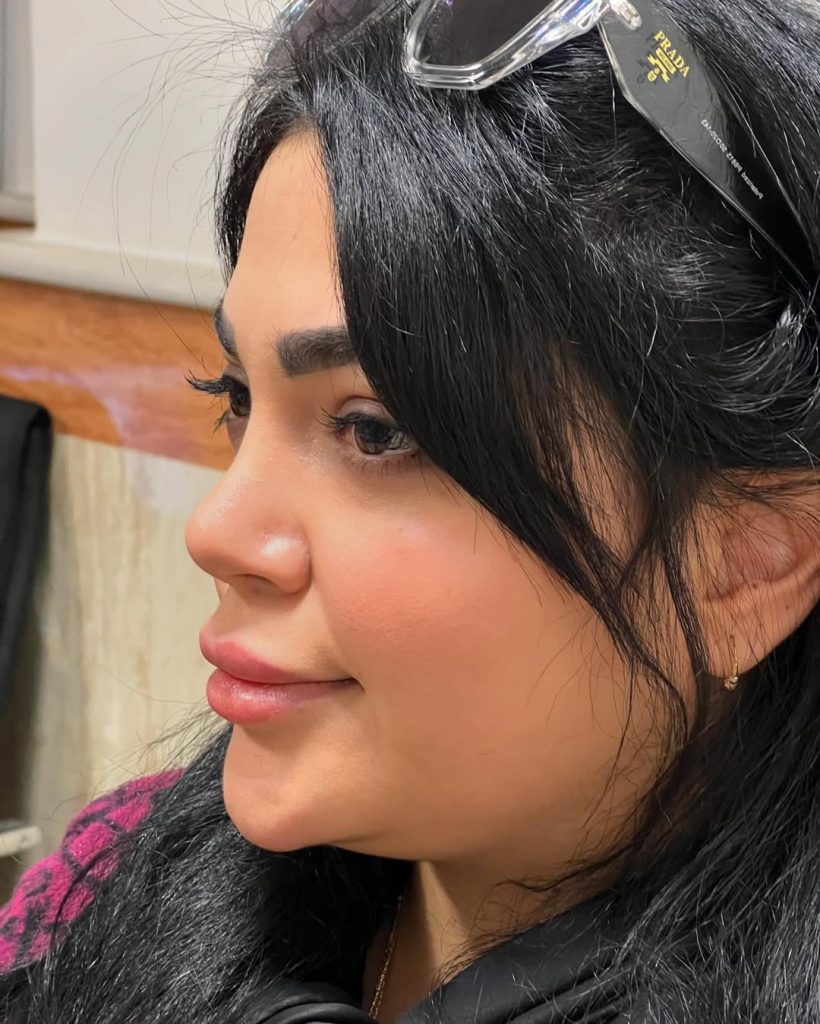 Three months after fleshy rhinoplasty