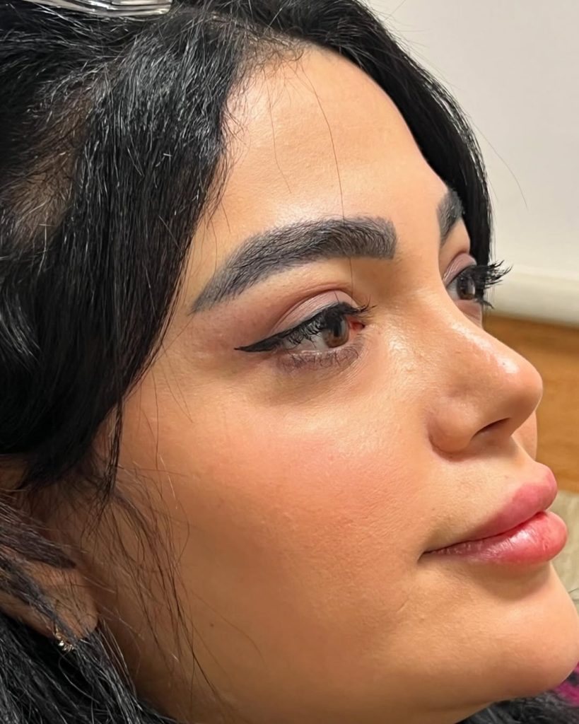 Three months after fleshy rhinoplasty1