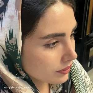 نمونه کار جراحی بینی در تبریز _ دکتر سودا کریمی