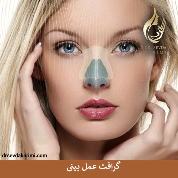 گرافت عمل بینی _ دکتر سودا کریمی