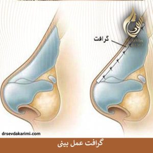 گرافت عمل بینی _ دکتر سودا کریمی
