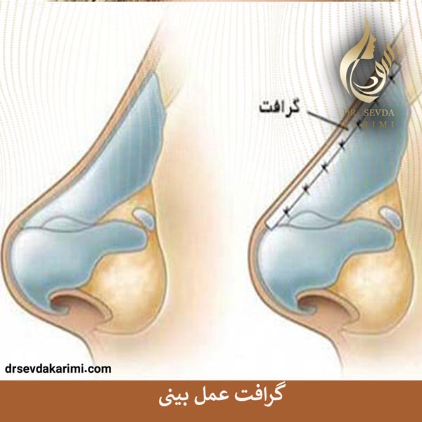 گرافت عمل بینی _ دکتر سودا کریمی