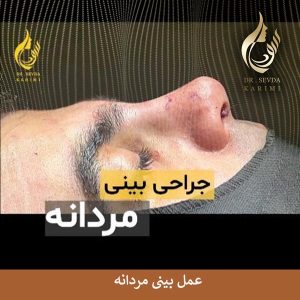 عمل بینی مردانه _ دکتر سودا کریمی