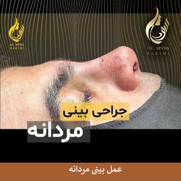 عمل بینی مردانه _ دکتر سودا کریمی