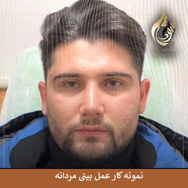 عمل بینی مردانه _ دکتر سودا کریمی
