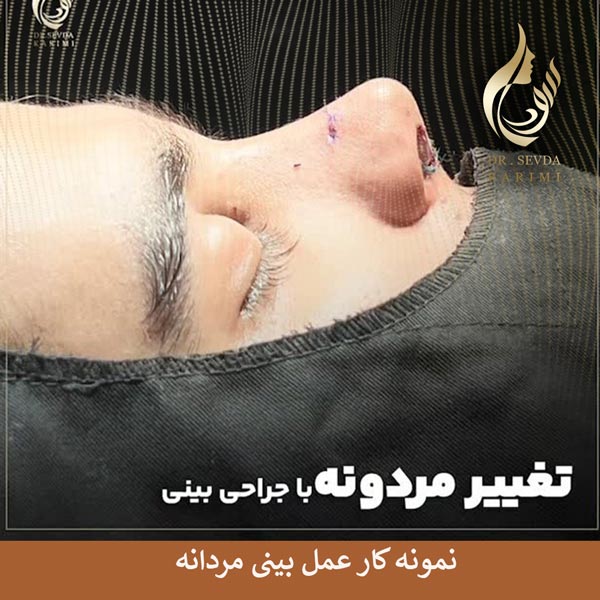 عمل بینی مردانه _ دکتر سودا کریمی