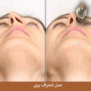 عمل انحراف بینی _ دکتر سودا کریمی