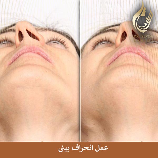 عمل انحراف بینی _ دکتر سودا کریمی