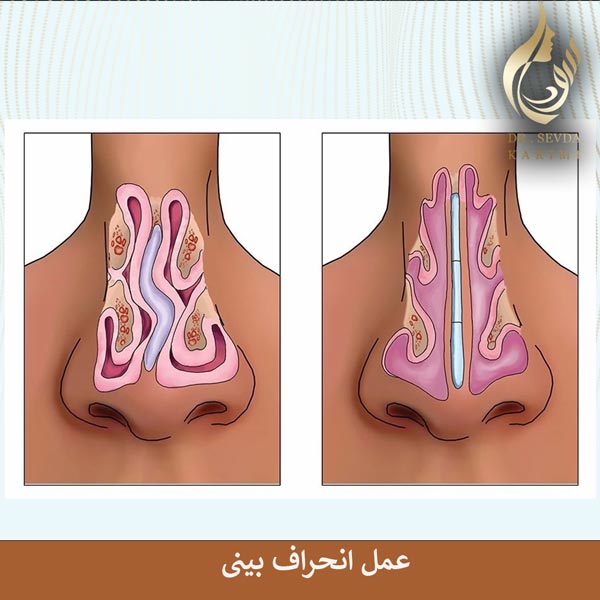 عمل انحراف بینی _ دکتر سودا کریمی