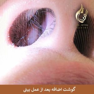 گوشت اضافه بعد از عمل بینی _ دکتر سودا کریمی