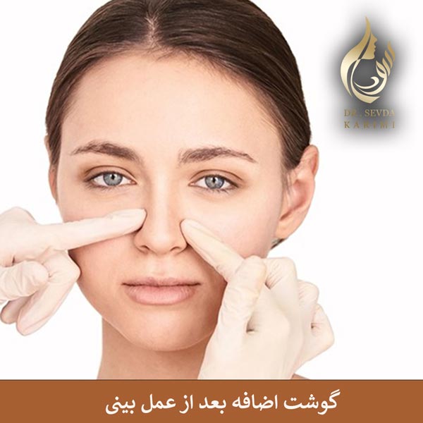 گوشت اضافه بعد از عمل بینی _ دکتر سودا کریمی